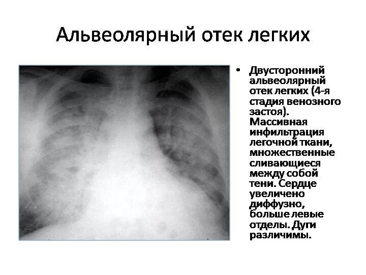 Очаговая инфильтрация легочной ткани рентген. Интерстициальный отек легкого. Альвеолярный отек легких. Альвеолярный отек легкого. Застойные изменения в легких