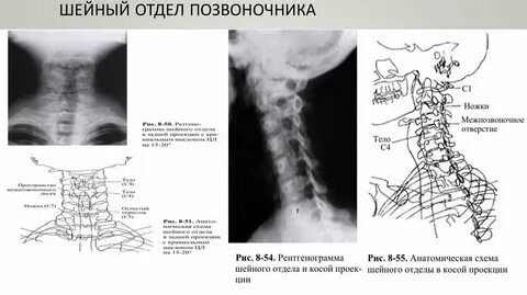 Унковертебральный артроз шейного отдела лечение у женщин