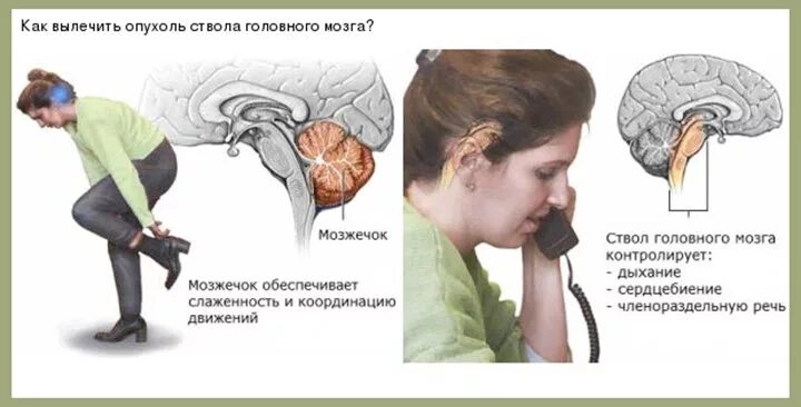 Объемное образование ствола головного мозга. Опухоль ствола головного мозга. Опухоль ствола головного мозга у детей симптомы. Новообразование в стволе головного мозга. Есть рак головы