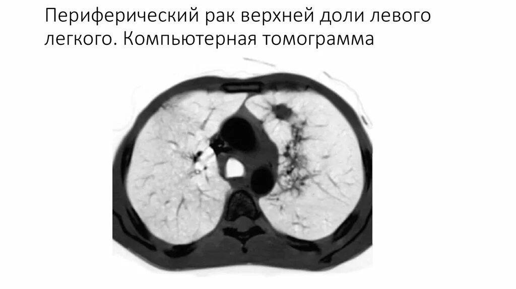 Периферическая опухоль верхней доли правого легкого. Периферическая карцинома легких кт. Аксиальная проекция кт легких. Карцинома лёгкого на кт. Образование верхней доли левого легкого