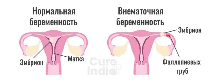 Почему происходит внематочная. Внематочная беременность цервикальная. Внематочная беременнос. Маточная и внематочная беременность. Труба при внематочной беременности.