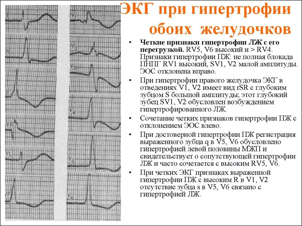 Очаговые изменения левого желудочка. Гипертрофия правого желудочка на ЭКГ. Электрокардиограмма при гипертрофии желудочков. Гипертрофия левого и правого желудочка на ЭКГ. Гипертрофия левого и правого желудочка сердца на ЭКГ.