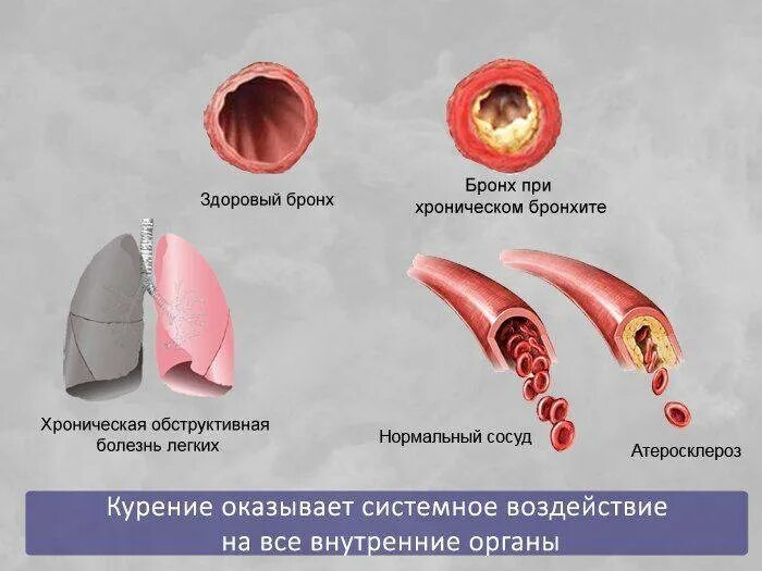 Бросил курить сосуды. Новообразования от курения. Влияние курения на дыхательную систему.