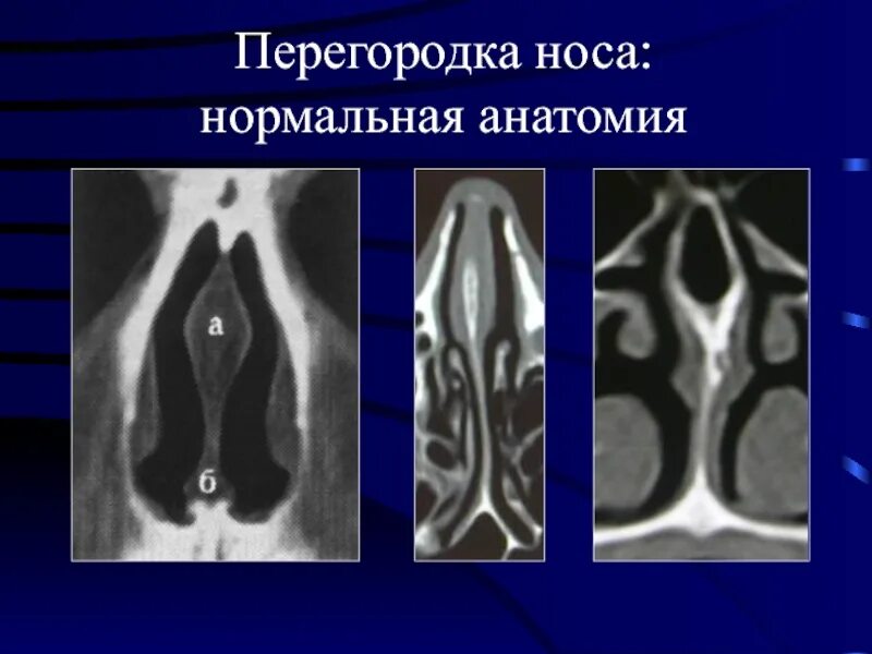 Костный гребень носовой перегородки. Септопластика искривление носовой перегородки. Искривление носовой перегородки кт. Искривление носовой перегородки с костным шипом. Пластика носовых раковин.