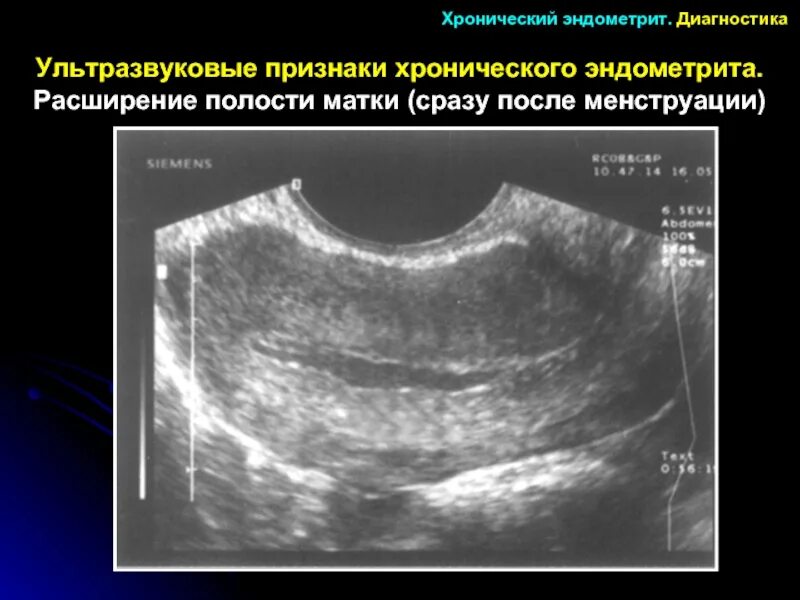 Острый послеродовой эндометрит. Метроэндометрит УЗИ признаки. Хронический эндометрит УЗИ картина. Послеродовый метроэндометрит. Расширение полости матки