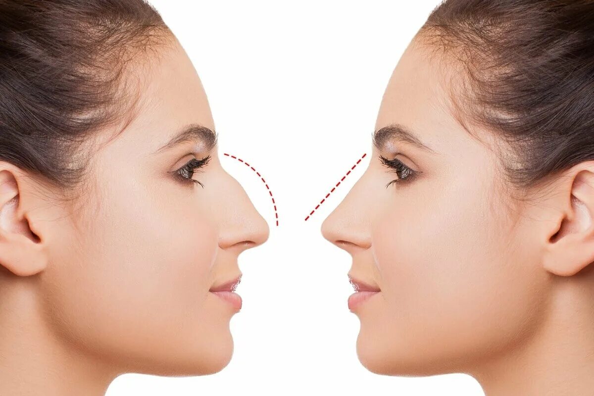 Ринопластика. Моделирование носа перед ринопластикой. Красивая форма носа. Исправление горбинки носа.