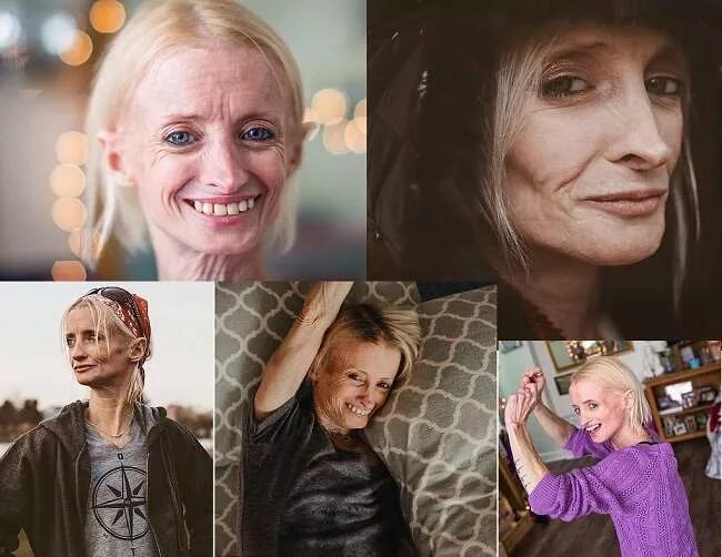 Преждевременное старение форум. Екатерина неженцева с нового уренгоя. Преждевременное старение. Прогерию - синдром преждевременного старения. Вероника коган ректор.