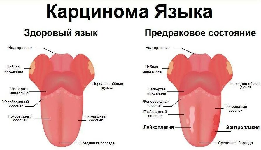 Солоно во рту причины у мужчин. Как выглядит онкология на языке сбоку.