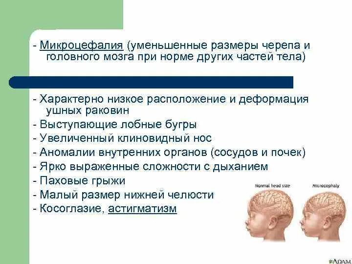 Микроцефалия причины. Микроцефалия головного мозга. Наследственная микроцефалия. Заболевание микроцефалия.