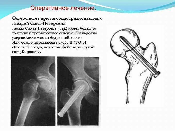 Операция остеосинтез шейки бедра. Перелом шейки бедра остеосинтез. Остеосинтез трехлопастным гвоздем Смит Петерсена. Остеосинтез бедренной кости операция. Шейка бедра перелом остеосинтез.