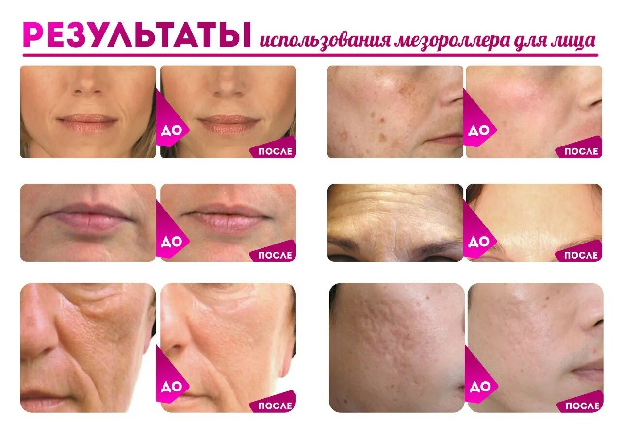 Мезороллер для волос до и после Мезороллеры для лица отзывы до и после в домашних