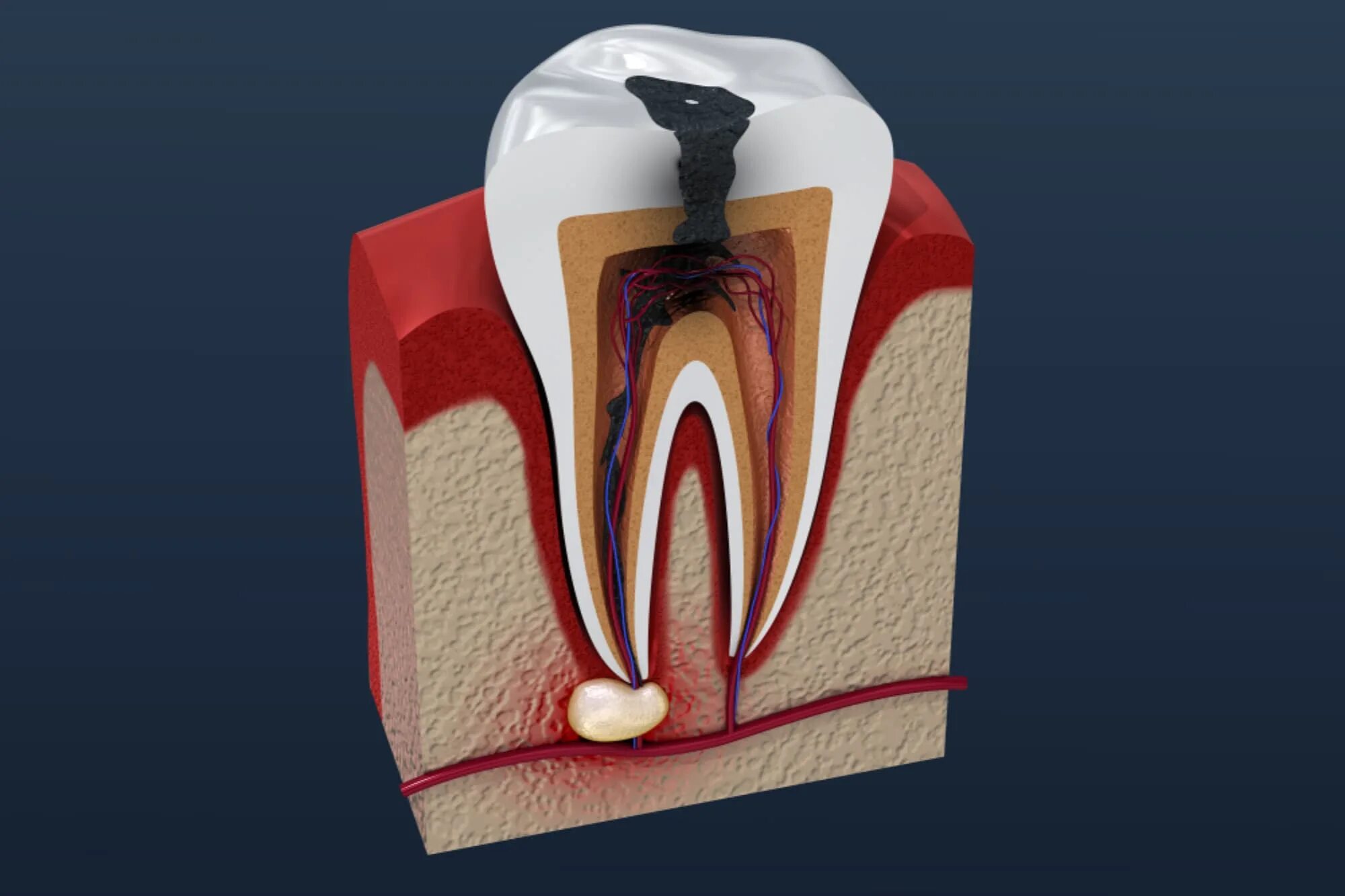 Root canal. Периодонтит 3 корневого зуба. Что такое периодонтит в стоматологии. Апикальный периодонтит.