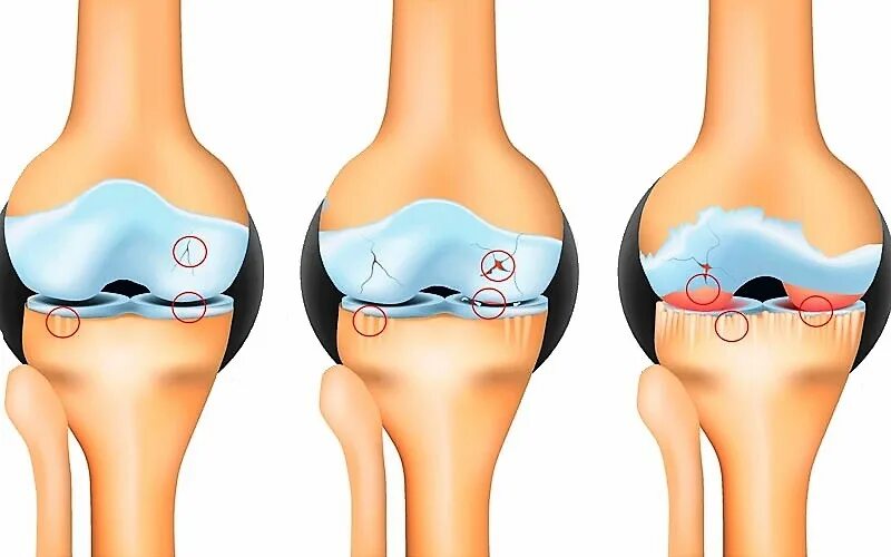Артроз коленного сустава мениск. Гонартроз коленного сустава. Гонартроз коленного сустава 1. Двухсторонний деформирующий гонартроз. Гонартроз 2 степени коленного сустава что это такое.