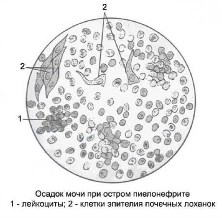 Лейкоциты при пиелонефрите. Лейкоциты при микроскопия мочи. Микроскопия мочи при остром пиелонефрите. Исследование осадка мочи лейкоциты. Лейкоциты в моче под микроскопом.