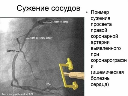 Признаки сужения сосудов