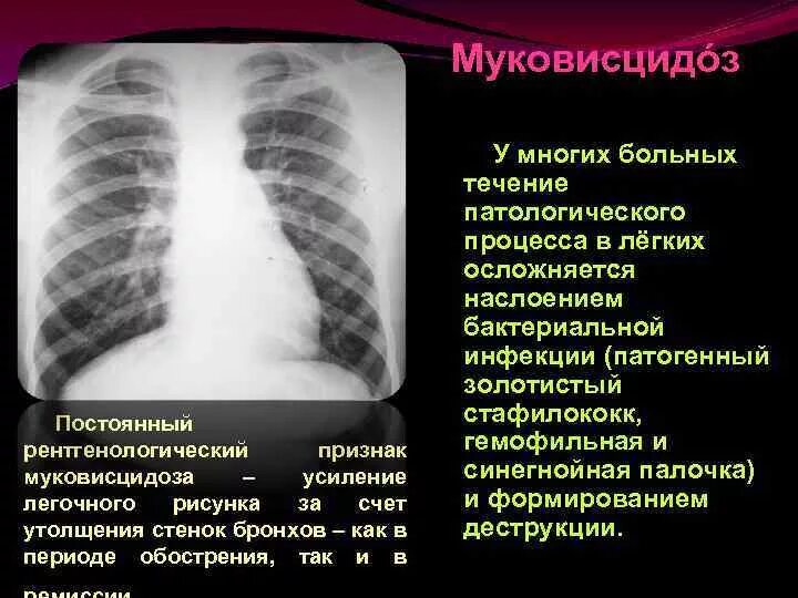 Легочный рисунок смешанного типа
