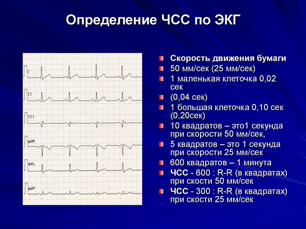 Подсчет ЧСС на ЭКГ 25 мм/с. Как определить ЧСС по ЭКГ 25 мм. Как определить частоту сердечных сокращений по электрокардиограмме. Как считать ЧСС по ЭКГ 50 мм. Экг сочи