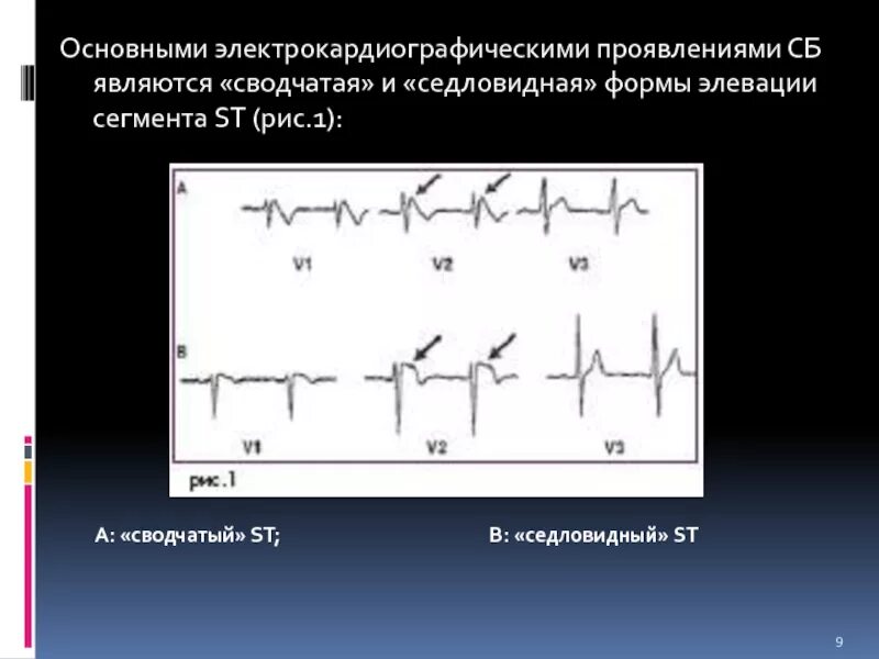 Эпизод депрессии st. Элевация сегмента St на ЭКГ. Норма элевации сегмента St. Седловидная элевация St. Преходящая элевация сегмента St.