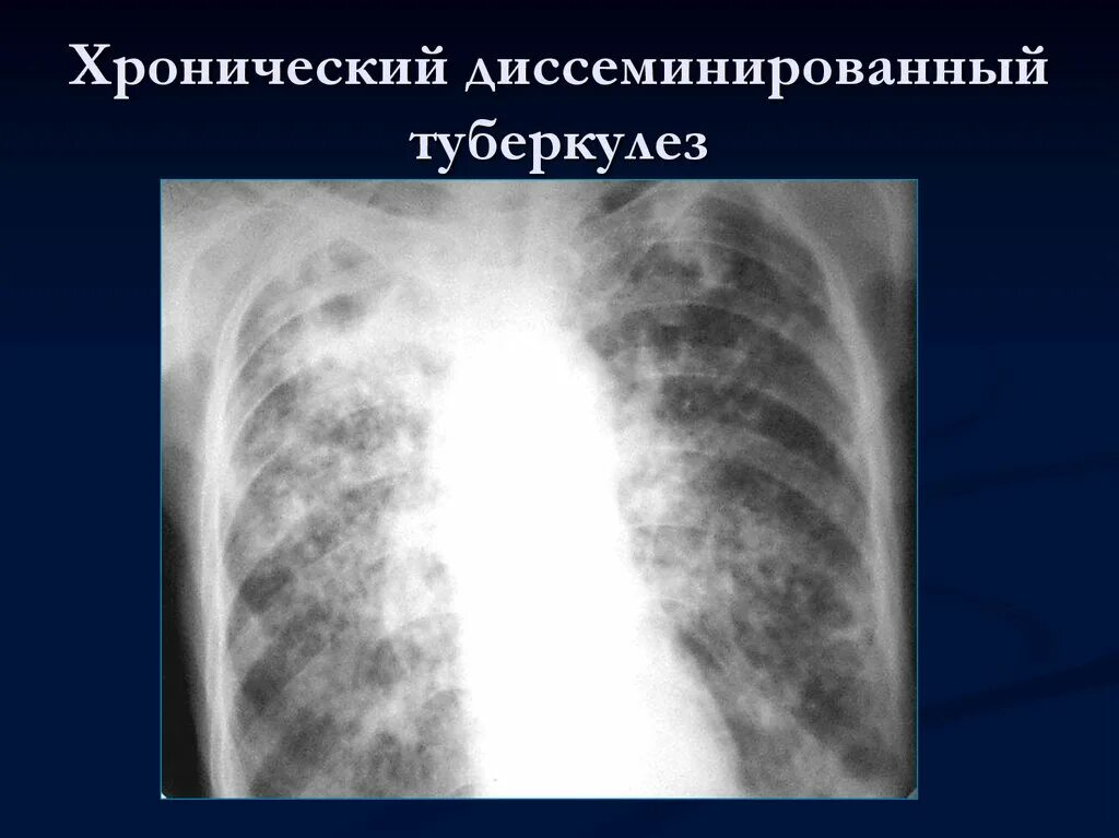 Формы диссеминированного туберкулеза. Острый диссеминированный туберкулез рентген. Хронический очаговый туберкулез на рентгене. Хронический диссеминированный туберкулез. Хронический диссеминированный туберкулез рентген.