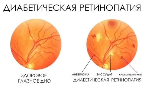 Фоновая ретинопатия что это у взрослых