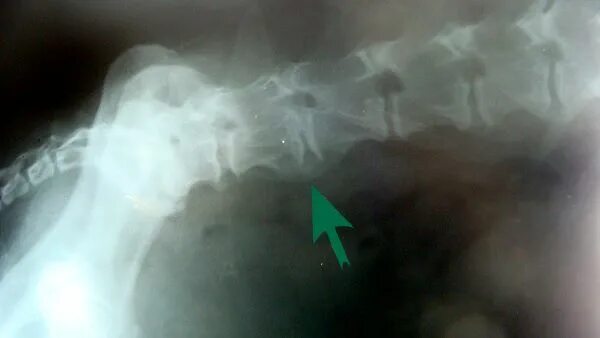 Спондилез у собак. Грыжа Шморля рентген. Спондилез у собак рентген. Позвоночная грыжа рентген. Грыжа Шморля на рентгенограмме.