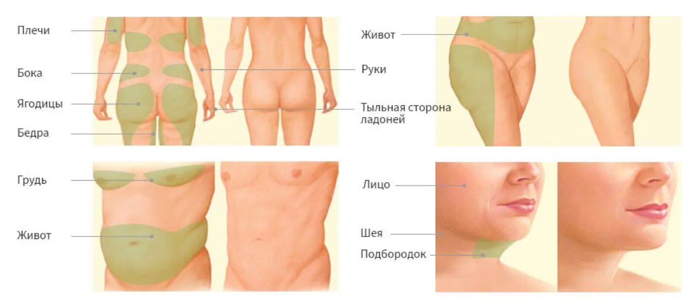 Липолитики схема введения. Схема введения липолитиков в живот. Липолитики схема уколов. Схема инъекций липолитиков в живот. Липолитики в живот купить для похудения инъекции