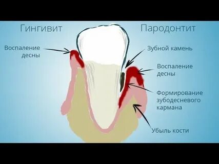 Больно нажимать на зуб лечение