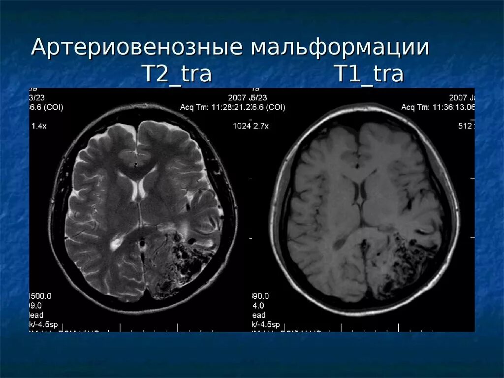 Сосудистая аномалия. Артериовенозные шунты кт. АВМ сосудов головного мозга. Артериовенозные мальформации сосудов головного мозга кт. Артериовенозная мальформация мрт.