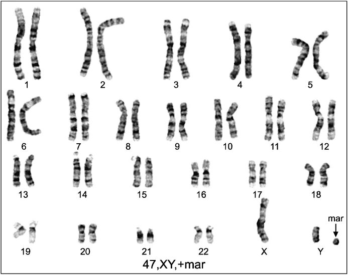 Хромосомы краба. Ген fbn1. Кариотип GTG. Хромосома. XY хромосомы.