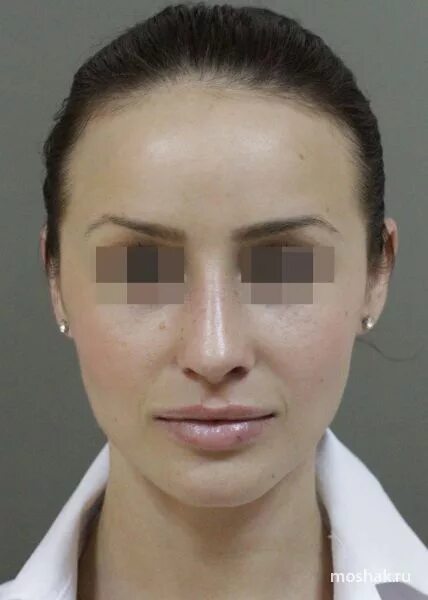 пластическая хирургия владивосток. пластическая хирургия владивосток. ринопластика мошак фото. пластическая хирургия владивосток. мошак сергей васильевич.