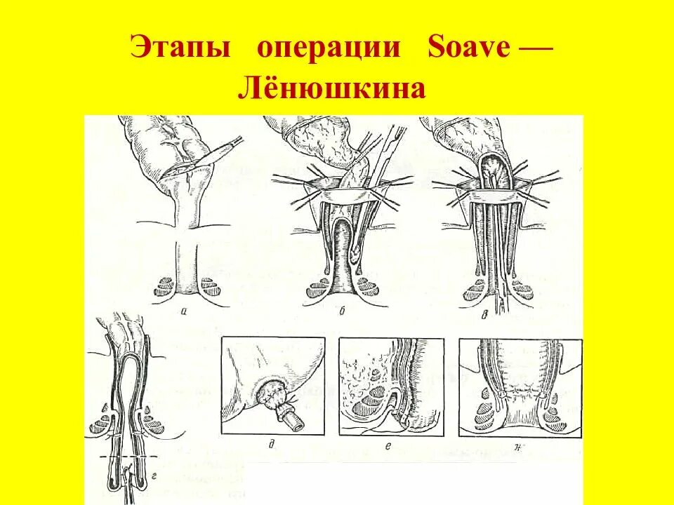 Операция Соаве Ленюшкина. Операция Свенсона-Хиатта при болезни Гиршпрунга. Операция Соаве при болезни Гиршпрунга. Операция Дюамеля Баирова.