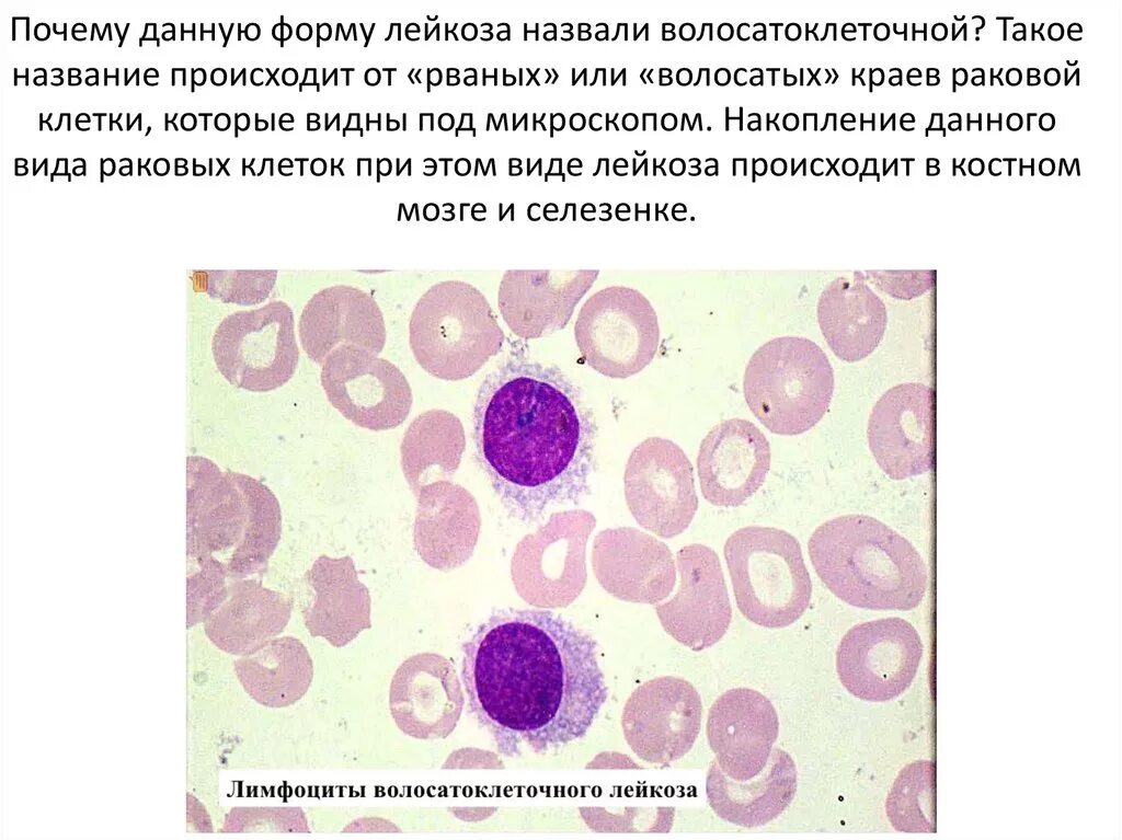 Волосатоклеточный лимфоциты. Волосатоклеточный лейкоз клетки. Волосатоклеточный лейкоз кровь. Волосатоклеточный лейкоз костный мозг.
