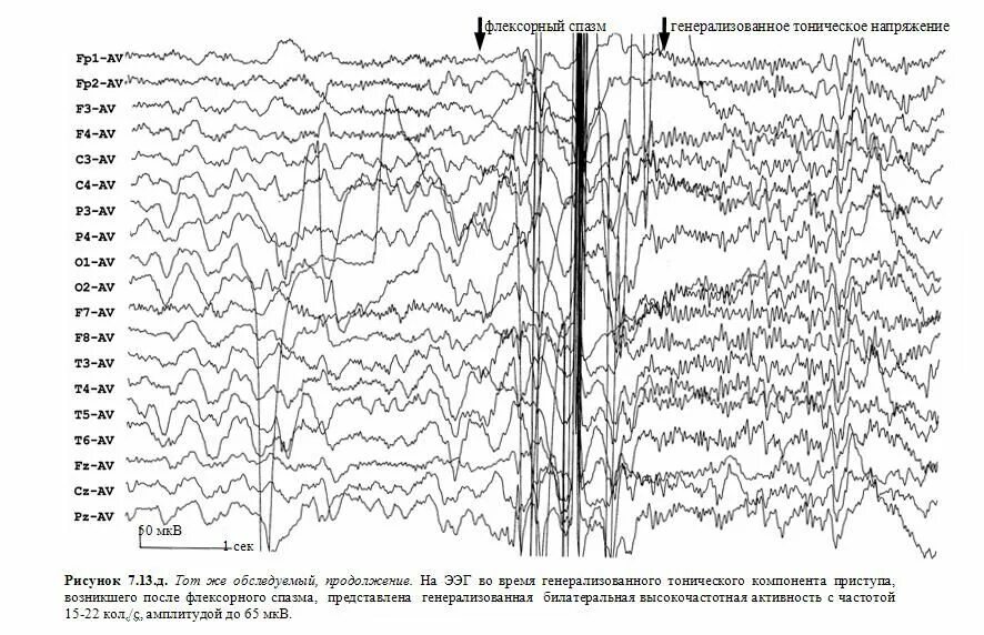 Эпи ээг. Эпилептические паттерны на ЭЭГ. Эпи активность при ЭЭГ. ЭЭГ головного мозга эпиактивность. ЭЭГ график с эпиактивностью.