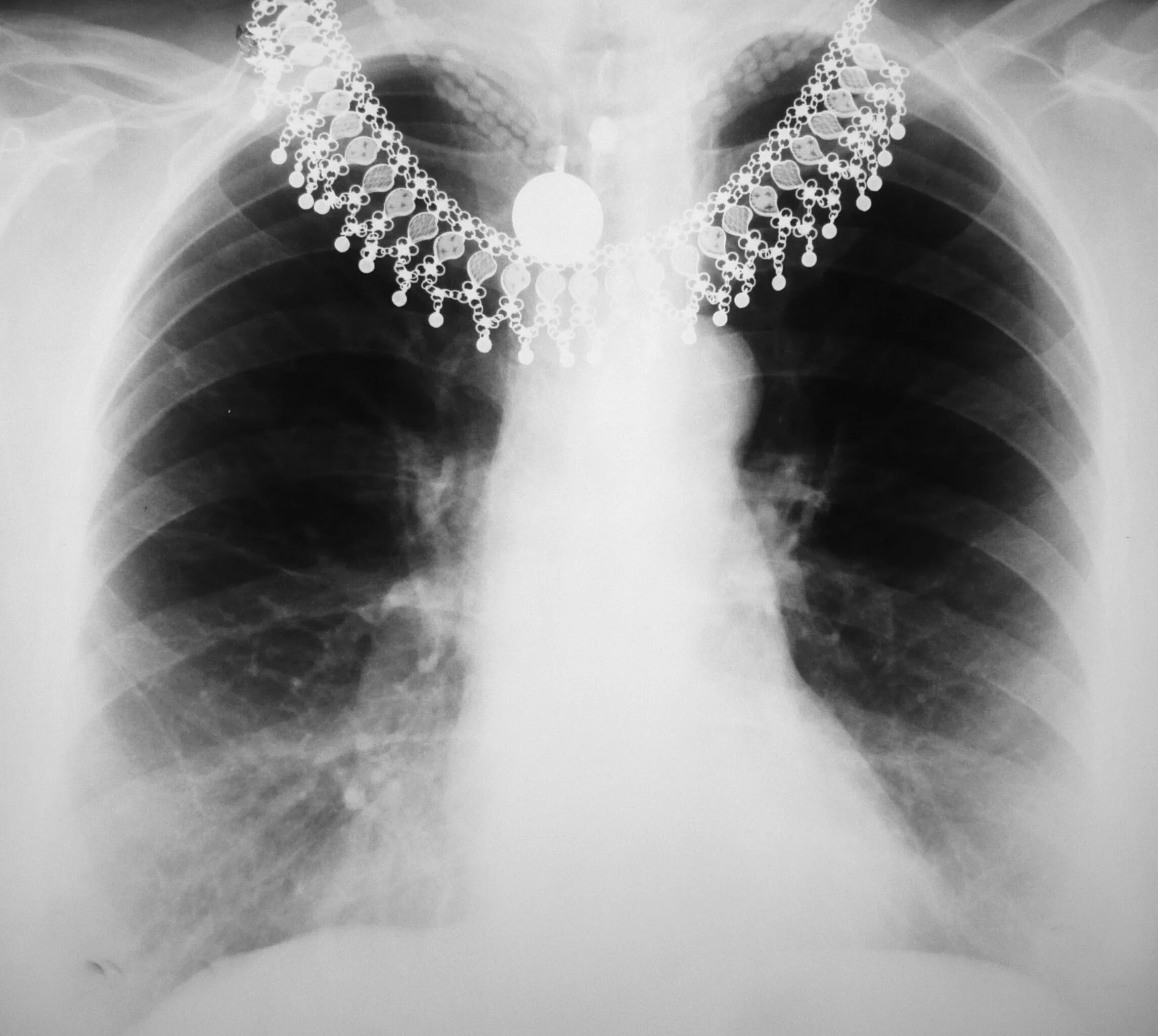 Рентген снимок грудины. Рентгенограмма грудины. Радиография грудной клетки. Рентген снимки грудной клетки.