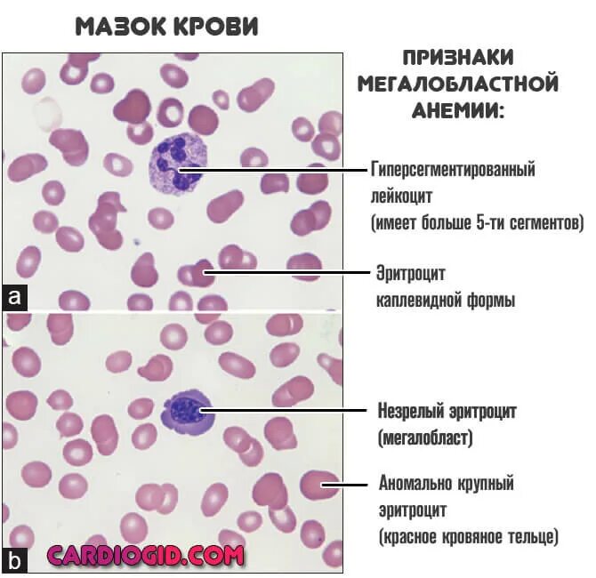 Признаки микро. Мегалобластная анемия мазок крови. Микроскопия мазка периферической крови. Мазок крови при мегалобластной анемии. Признаки мегалобластной анемии.