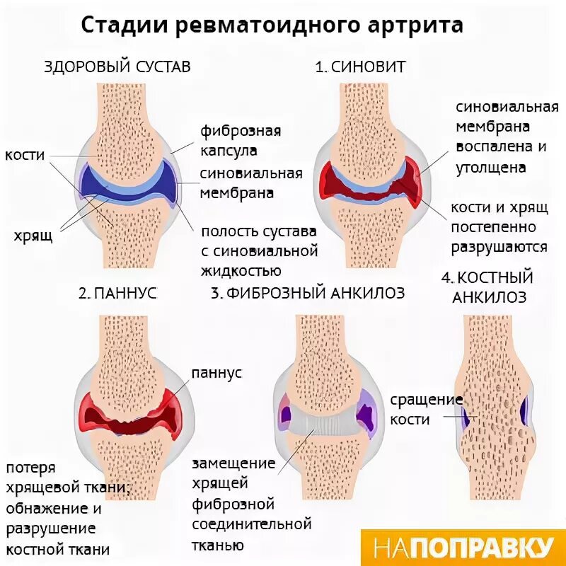 Паннус ревматоидный артрит. Ревматоидный артрит анкилоз. Ревматоидный артрит ранняя стадия. Артрит рук народное лечение