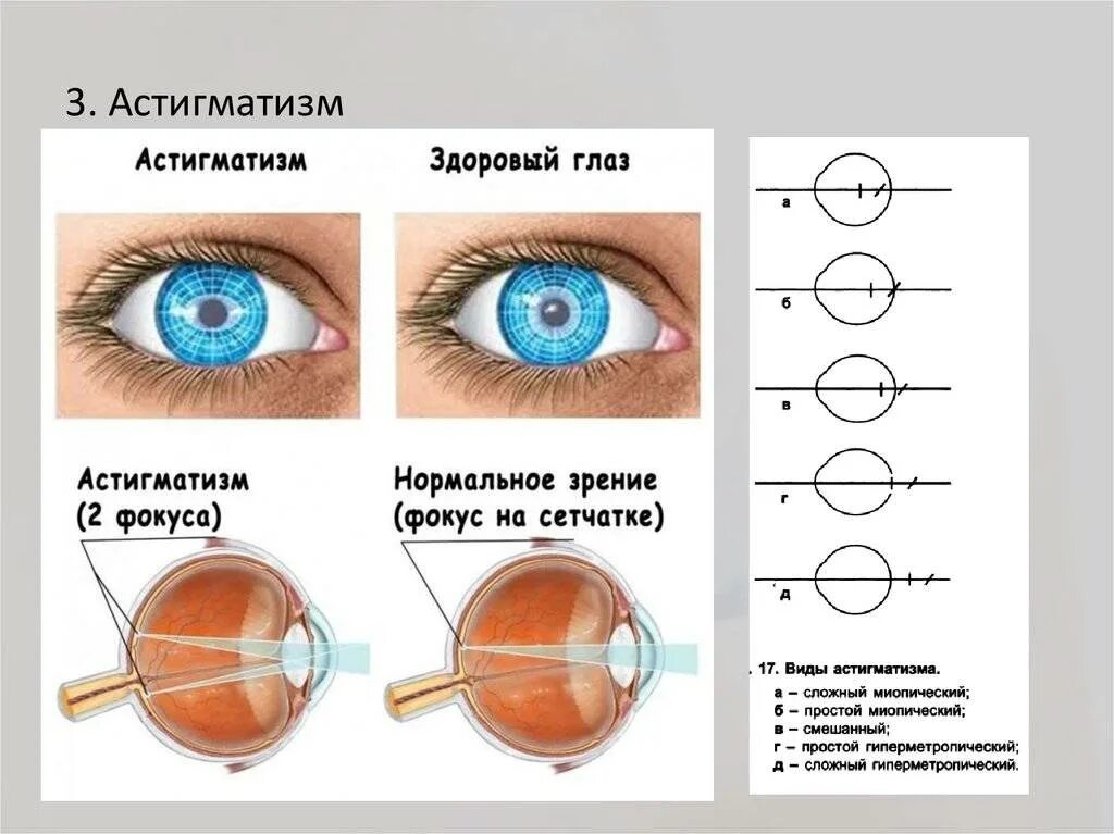 Глазное зрение 1. Линзы для сложного миопического астигматизма. Сложный гиперметропический астигматизм у детей в 1 год. Линзы -2.25 и -2.5 астигматизм. Сложный миопический астигматизм степени.
