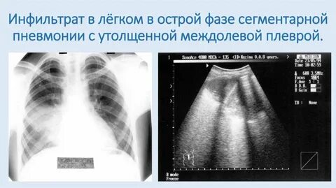 Разрешение инфильтрации в легких