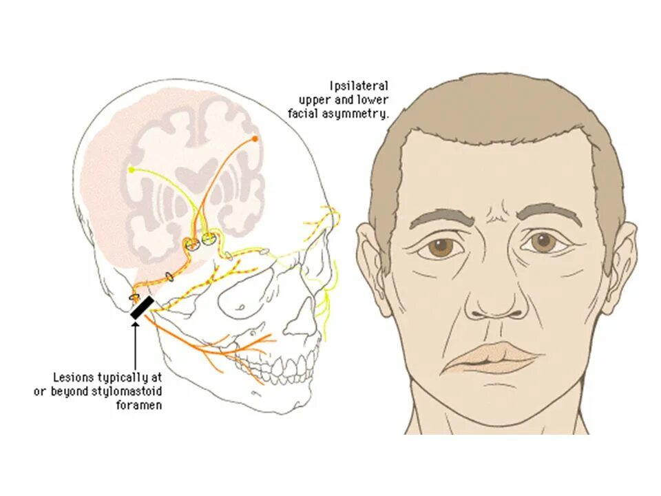 Правый лицевой нерв. Паралич тройничного нерва лица. Асимметрия лица при ЧМТ. Неврит лицевого нерва.