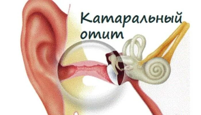 Острый катаральный средний отит. Острый двусторонний катаральный средний отит. Экссудативный отит перепонка. Катаральный средний отит клиника. Двухсторонний гнойный