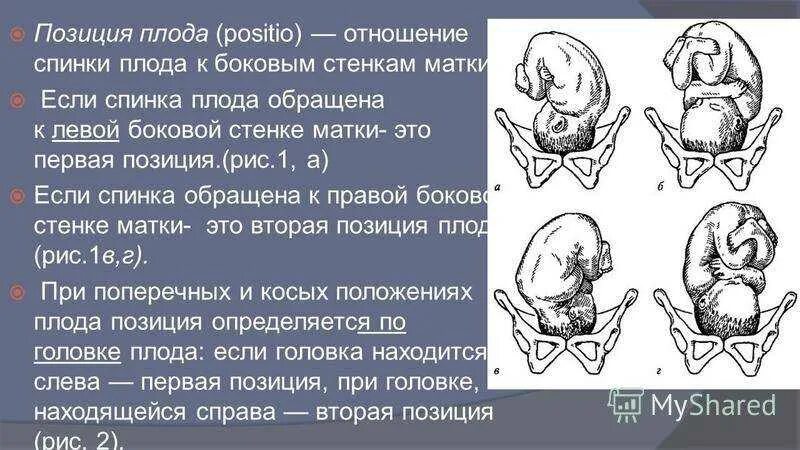 Головное предлежание плода первая позиция передний вид. Продольное положение плода положение плода головное. Тазовое предлежание 1 позиция передний вид. Продольное головное предлежание плода 2 позиция передний вид. Позиция плода при поперечном положении