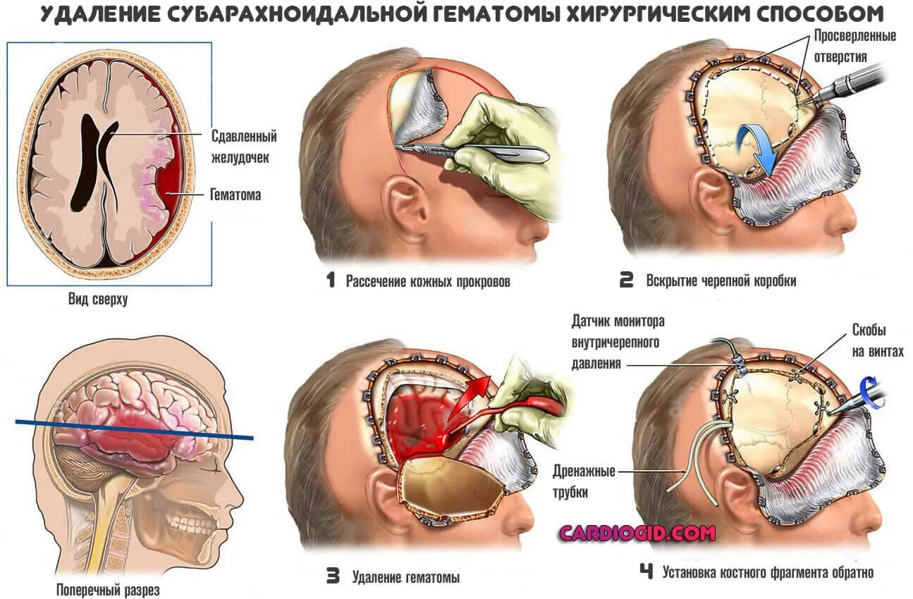 Субдуральная гематома Трепанация. Трепанация черепа при инсульте. Трепанация черепа гематома. Трепанация черепа при опухоли. Гематома мозга операция