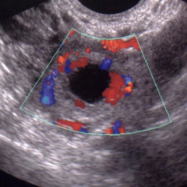 Ложное плодное яйцо на УЗИ. Внематочная беременность 6 недель УЗИ. Внематочная беременность 5-6 недель УЗИ. Анэмбриония – пустое плодное яйцо. Можно перепутать беременность с кистой