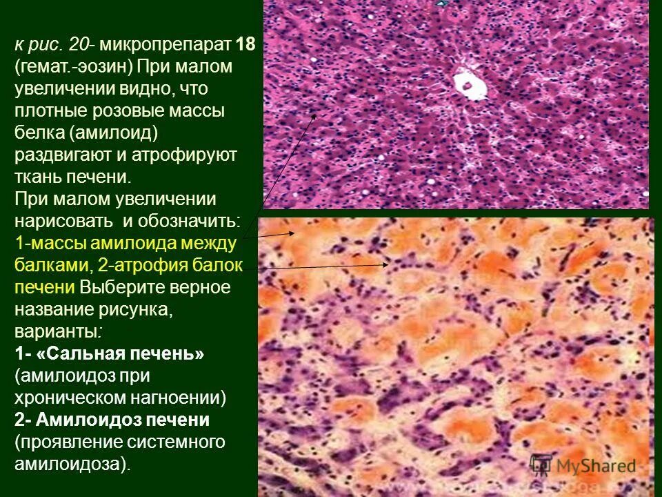 менингококковый гнойный менингит микропрепарат. индекс гистологической активности хронических гепатитов. мостовидный некроз гепатоцитов. выраженная лейкоцитарная инфильтрация цитология шейки матки. умеренно выраженная лейкоцитарная инфильтрация в мазке на цитологию.