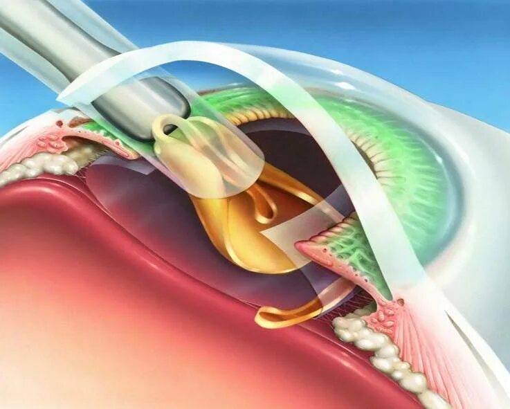 Операция факоэмульсификация катаракты. Катаракта факоэмульсификация. Аккомодирующие ИОЛ. Искусственные интраокулярные линзы (ИОЛ).