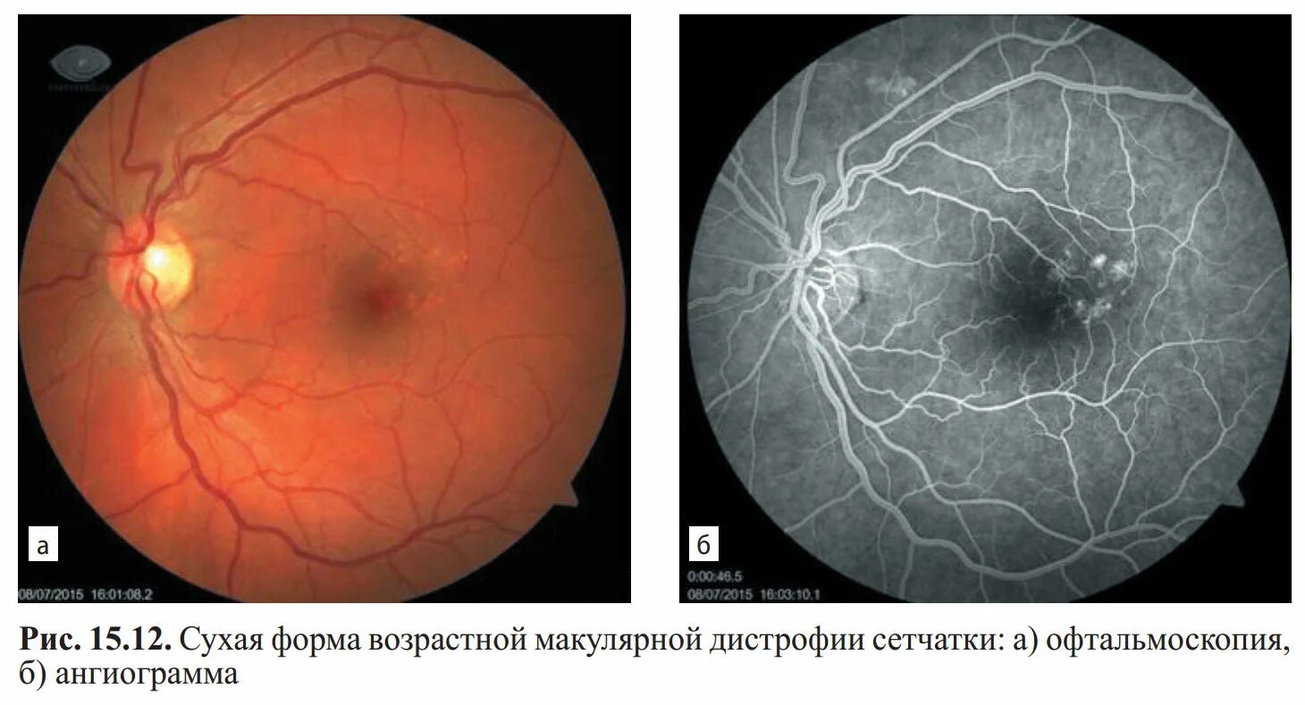 Лечение дегенерации макулы. Разрыв сетчатки офтальмоскопия. Беспигментная дистрофия сетчатки. Возрастная макулярная дегенерация сетчатки. Макулярный разрыв офтальмоскопия.