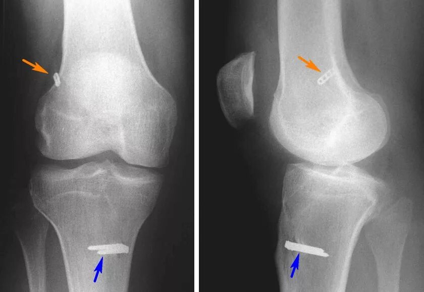 Гемартроз коленного сустава рентген. Перелом мениска рентген. Мениск коленного сустава рентген. Артропластика ПКС коленного сустава. Трещина связке