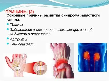 Код мкб синдром запястного канала
