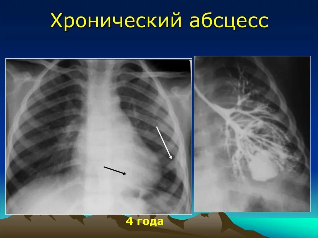 После абсцесса легкого. Хронический абсцесс рентген. Хронический абсцесс легкого рентген. Рентгенологическая картина абсцесса легкого.