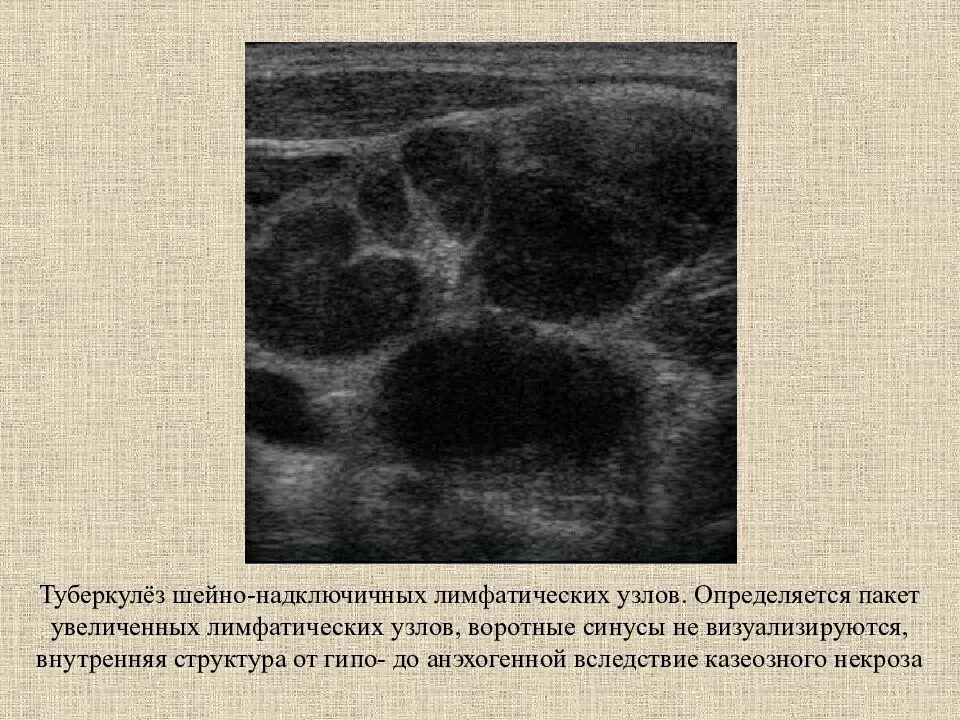 Обследование при увеличении лимфатических узлов. Туберкулез шейных лимфатических узлов рентген. казеозная форма туберкулеза периферических лимфатических узлов. туберкулез лимфоузлов узи. туберкулез лимфатических узлов по узи.